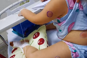 Những vết sưng tấy trên chân bé P. có mầm mống của "vi khuẩn ăn thịt người". Ảnh: Người lao động