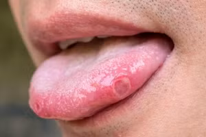 6 hiện tượng ở lưỡi cảnh báo ung thư trong cơ thể