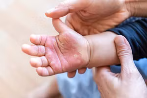 Bác sĩ hướng dẫn cách sơ cứu đúng khi trẻ bị bỏng 