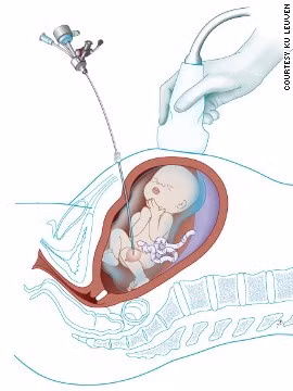 Rô bốt có thể khắc phục tắc nghẽn đường tiết niệu khi trẻ không thể đi tiểu trong bài thai và bàng quang của trẻ bị phình to