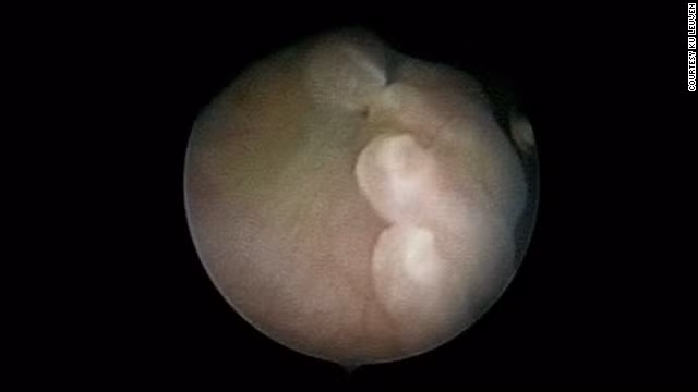 Cánh tay của thai nhi qua hình ảnh 3D của rô bốt.