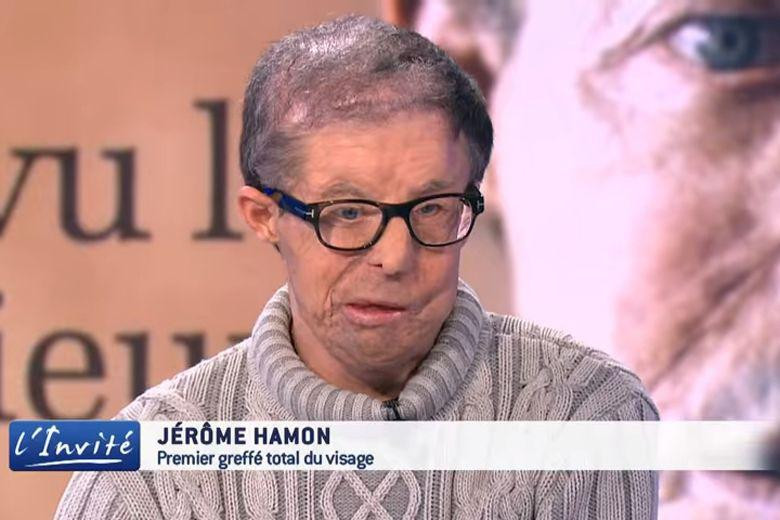 Ông Jerome Hamon là người đầu tiên trải qua hai cuộc phẫu thuật ghép mặt. Ảnh: Strait Times. Ông Jerome Hamon là người đầu tiên trải qua hai cuộc phẫu thuật ghép mặt. Ảnh: Strait Times.