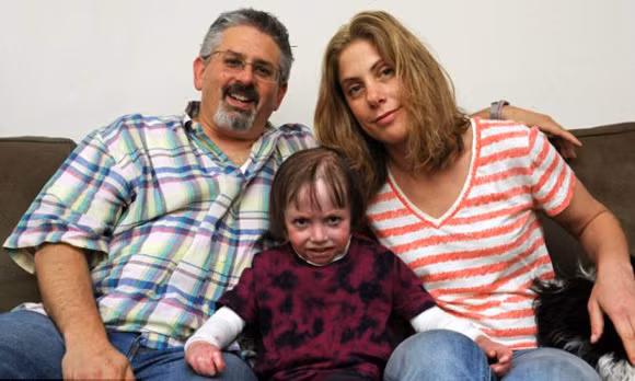 Bệnh lạ: Da mong manh, dễ rách toạc bất cứ lúc nào