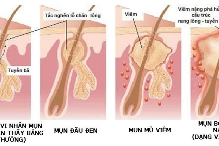 5 bài thuốc trị trứng cá hiệu quả