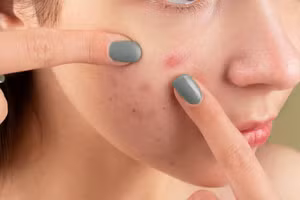 Đặc tính chống viêm của tỏi giúp giảm mẩn đỏ và sưng tấy do mụn trứng cá. (Ảnh: ITN)