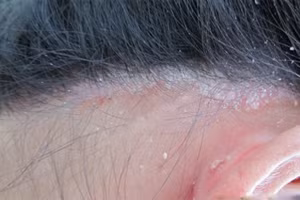 Vảy nến da đầu gây ngứa ngáy khó chịu cho người bệnh