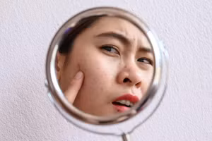 Phản ứng đầu tiên của nhiều người khi đối mặt với mụn trứng cá là nặn và gãi bằng tay. (Ảnh: ITN)