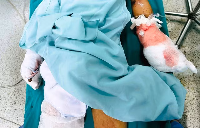 Nam sinh bị nát bàn tay khi chế tạo pháo. (Ảnh: BV cung cấp)