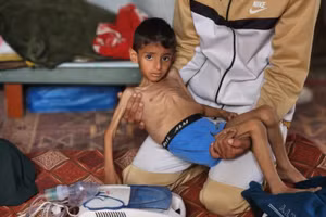 Bé Osama Kamal al-Raqab đang được điều trị suy dinh dưỡng tại Khan Younis, phía nam Gaza, ngày 14/4. Ảnh: Hani Alshaer/Anadolu.