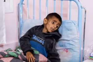 Nhiều trẻ em ở Gaza bị suy dinh dưỡng nghiêm trọng.