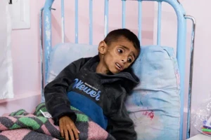 Nhiều trẻ em ở Gaza bị suy dinh dưỡng nghiêm trọng.