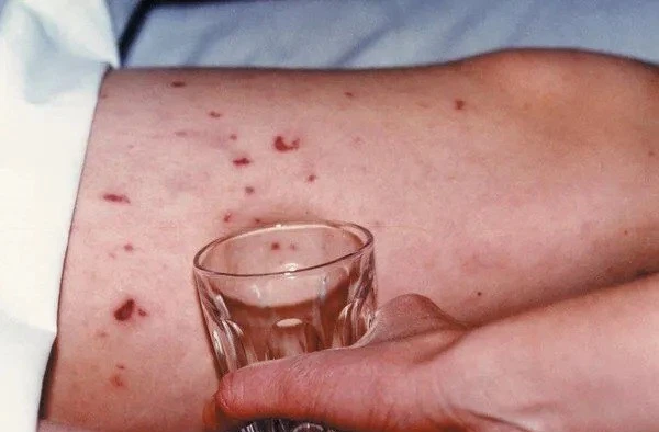 Dấu hiệu mắc bệnh viêm não mô cầu. 