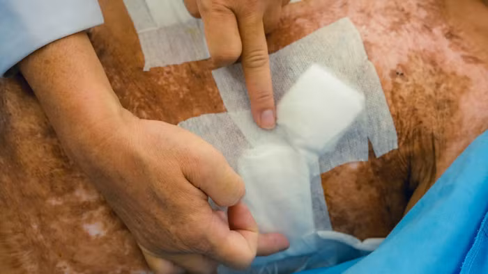 Bệnh nhân T. từng bị bỏng 60% cơ thể cách đây 6 năm.