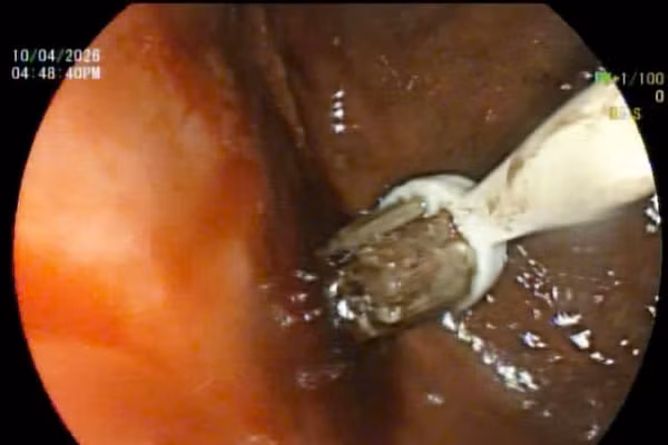 1 trong 3 bàn chải được nội soi và gắp ra trong đường tiêu hóa bệnh nhân điều trị tại Bệnh viện Trung ương Huế.