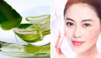 Thần dược tự nhiên trị mụn, chị em nào cũng cần 