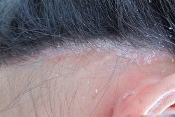 Vảy nến da đầu gây ngứa ngáy khó chịu cho người bệnh