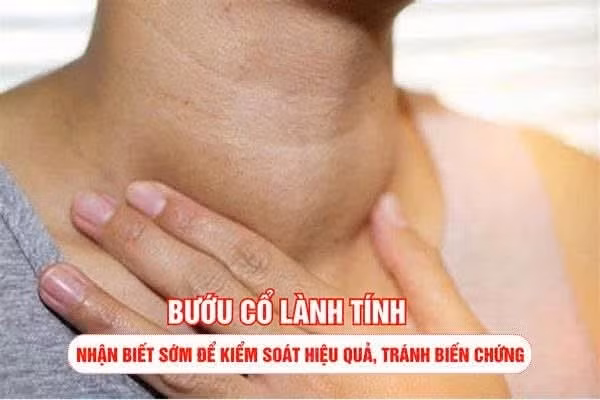 Tuyến giáp phì đại gây bướu cổ lành tính