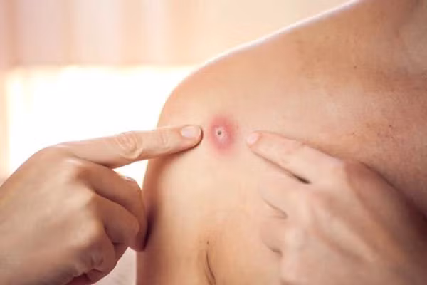  Mụn nước nổi khắp cơ thể một trong những dấu hiệu bệnh đậu mùa khỉ ( ảnh internet)