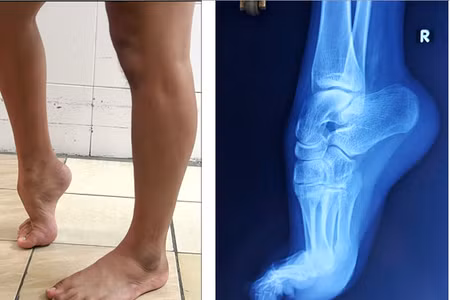 Hình ảnh lâm sàng và X-Quang trước điều trị ca biến dạng bàn chân thuổng chân phải.