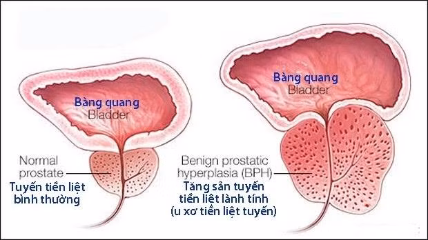 benh doc quyen o phai may rau.jpg