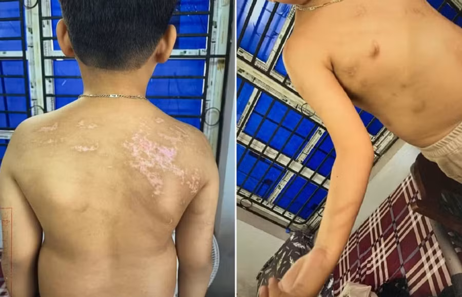 Cháu N.Đ.B.K có 21 vết sẹo và 20 vết rối loạn sắc tố da màu nâu.