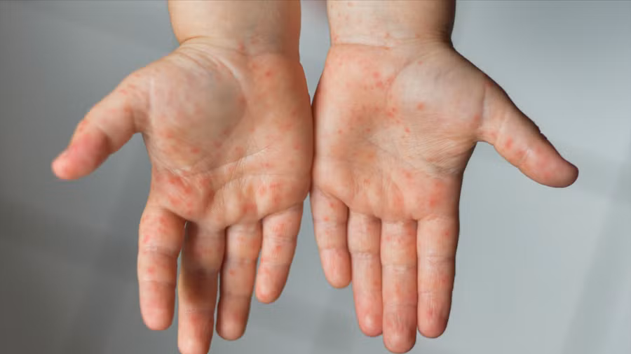 Hình ảnh điển hình của bệnh tay chân miệng với các nốt phát ban ở tay, chân và vùng miệng, thường gặp ở trẻ nhỏ. Ảnh minh hoạ.