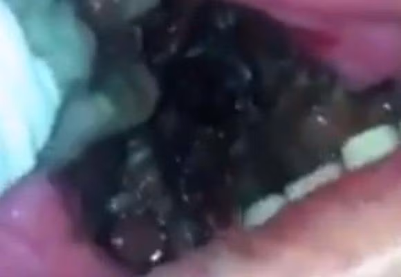 Người đàn ông bị ổ giòi ký sinh trong miệng