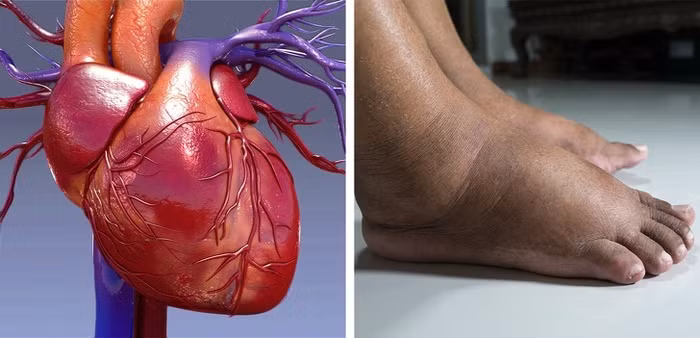 Nhìn bàn chân và mắt cá chân sưng đủ biết sức khỏe thế nào?