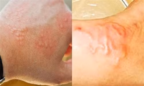 Trẻ xuất hiện nhiều nốt mẩn đỏ dưới da nhiều ngày khong khỏi cần đến ngay cơ sở y tế khám chữa.
