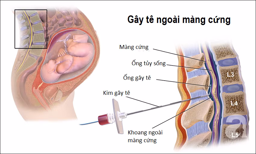 Tất tật những điều các mẹ cần biết về phương pháp giảm đau phổ biến khi sinh nở ảnh 3