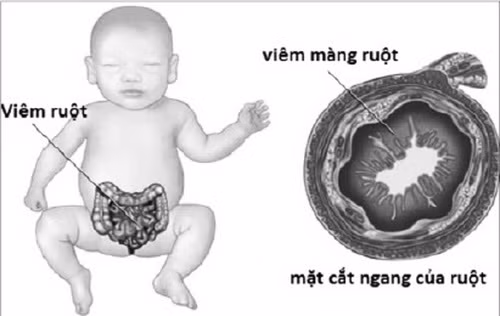 cai-thien-hoi-chung-kem-hap-thu-1