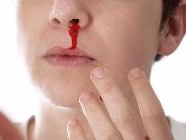 Triệu chứng dễ nhầm sốt xuất huyết và sốt thường, để lâu nguy hiểm tính mạng - Ảnh 3.