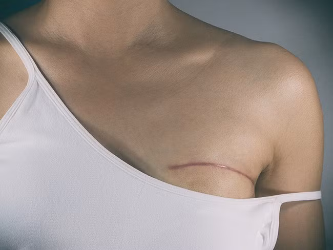 Bác sĩ chỉ ra những dấu hiệu trên cơ thể cảnh báo nguy cơ ung thư vú mà chị em nào cũng cần cảnh giác - Ảnh 2. Bác sĩ chỉ ra những dấu hiệu trên cơ thể cảnh báo nguy cơ ung thư vú mà chị em nào cũng cần cảnh giác - Ảnh 2.