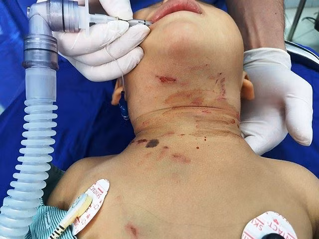 Bé trai 3 tuổi bị chó hàng xóm cắn thủng khí quản - ảnh 1