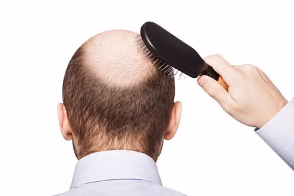 Bỏ 200 triệu đi cấy tóc chữa hói, quý ông Hà Nội nhận trái đắng Bỏ 200 triệu đi cấy tóc chữa hói, quý ông Hà Nội nhận trái đắng