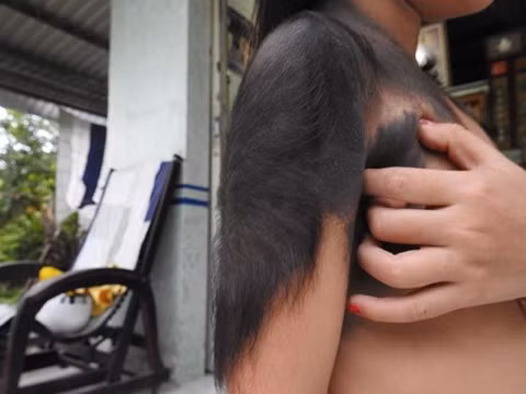  Từ một vết bớt nhỏ trên mặt, lông lan rộng ra khắp cơ thể cháu Bích. Ảnh: Thanhnien. 