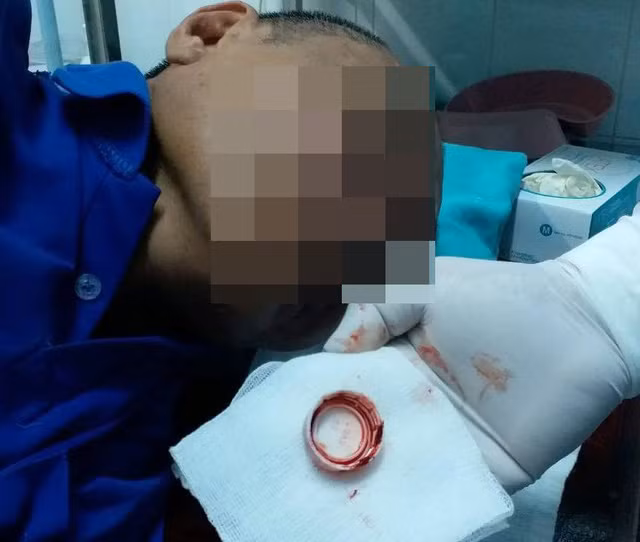 Ông D. suýt gặp nguy vì nuốt phải nắp chai nhựa và bị kẹt trong cuống họng.