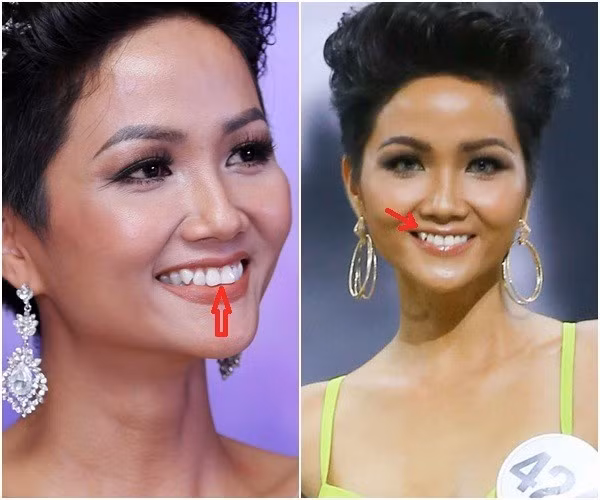 Các nàng hậu Việt sau khi từ bỏ răng khểnh, nhan sắc sẽ đi về đâu?