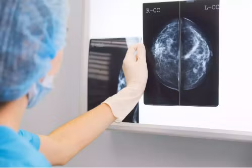 Một người hiến tạng, ba người nhận chết vì lây ung thư vú