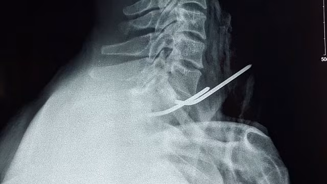 Hy hữu bệnh nhân bị đinh y tế đâm thủng thực quản - Hình 1
