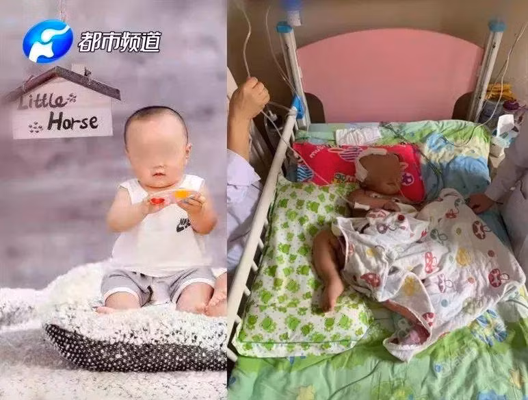Cậu bé có tên Lele, 16 tháng tuổi bị ngã nhiều lần khi đang tập đi gây tổn thương não. 