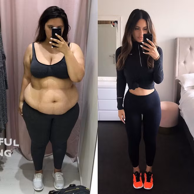 Cắt dạ dày là phương pháp dành cho những người có cân nặng vượt ngưỡng. Ảnh: Ariana Omipi. Ba me 3 con tu vong vi chi con 31 kg sau khi cat da day giam can hinh anh 2