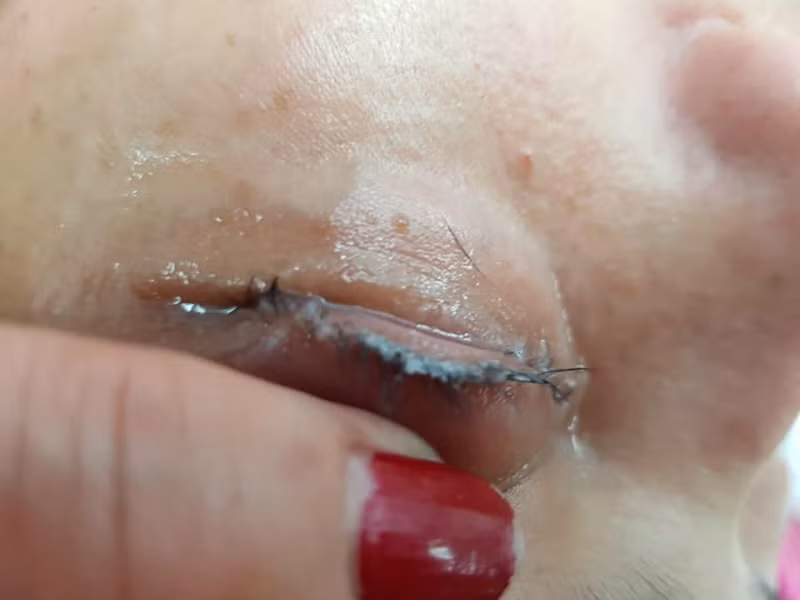 Cô gái đau đớn lĩnh hậu quả với đôi mắt sưng húp, rụng sạch lông mi vì nối mi bằng keo dán sắt - Ảnh 4.