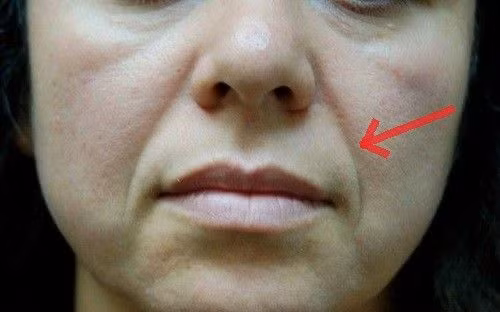 Vân pháp lệnh thường chỉ xuất hiện sau độ tuổi 30.