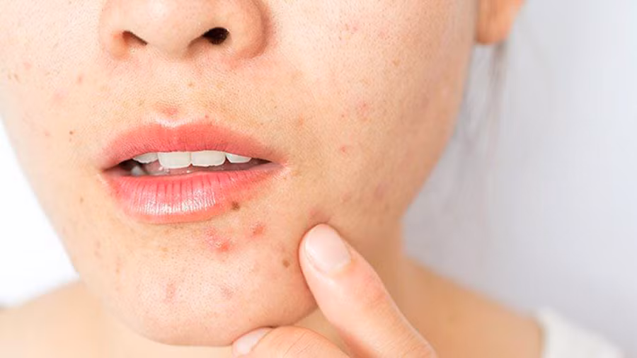 Nên điều trị mụn trứng cá sớm, tránh nặn mụn, sử dụng hóa chất trị mụn. (Ảnh: ITN)
