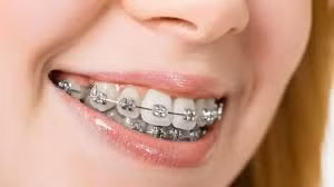 Người trưởng thành có nên niềng răng?