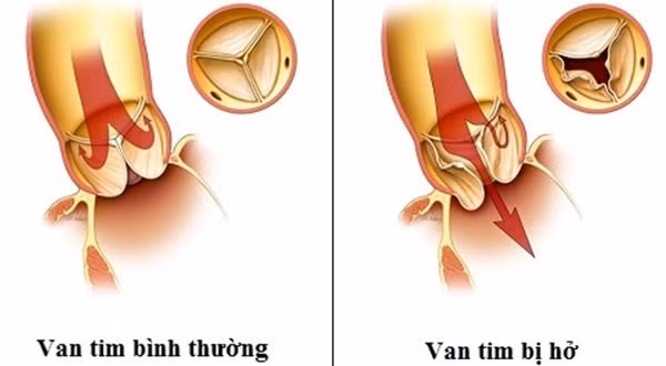 Căn bệnh hở van tim ca sĩ Tuấn Hưng đang mắc phải nguy hiểm thế nào? ảnh 1 ca si tuan hung bi ho van tim, can benh nay lieu co nguy hiem? - 3