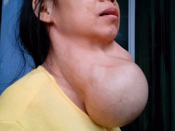 Thiếu i ốt và vi chất đang khiến bệnh lý tuyến giáp tăng nhanh (ảnh minh họa)
