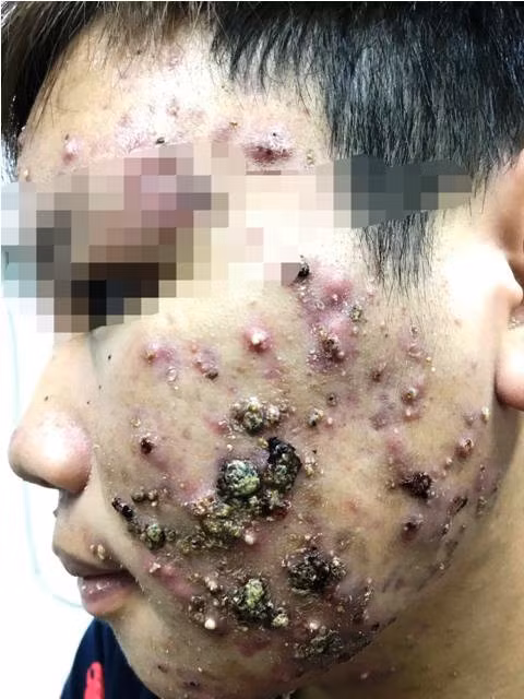 Bôi kem trộn, mặt thiếu nữ sưng vù, chi chít mụn mủ chưa từng thấy-3