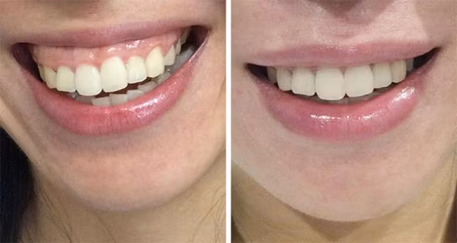 Phẫu thuật hở lợi - Trả lại nụ cười đẹp cho bạn